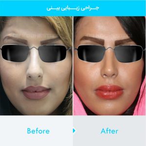 rhinoplasty-387