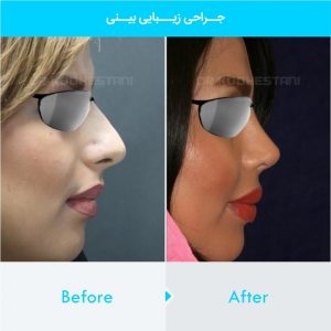 rhinoplasty-388