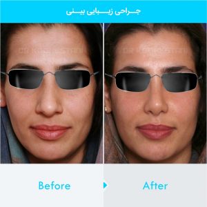 rhinoplasty-389