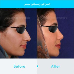 rhinoplasty-390