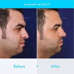 rhinoplasty-393