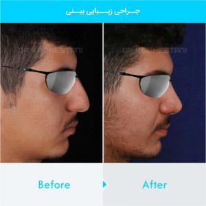 rhinoplasty-395