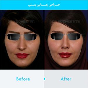 rhinoplasty-397