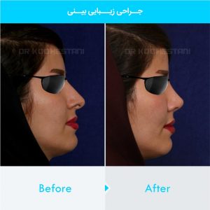 rhinoplasty-398