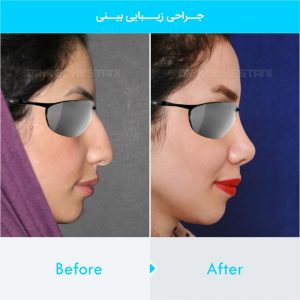 rhinoplasty-401