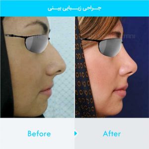 rhinoplasty-404