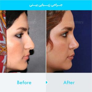 rhinoplasty-409