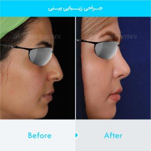 rhinoplasty-412