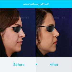 rhinoplasty-415