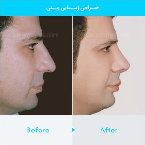 rhinoplasty-418