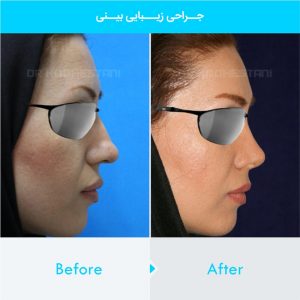 rhinoplasty-420