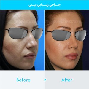 rhinoplasty-421