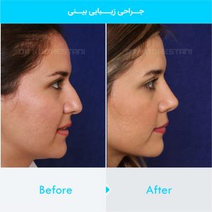 rhinoplasty-423