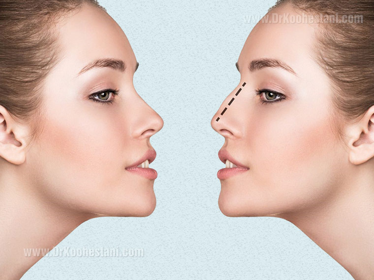 Cosmetic and functional rhinoplasty 